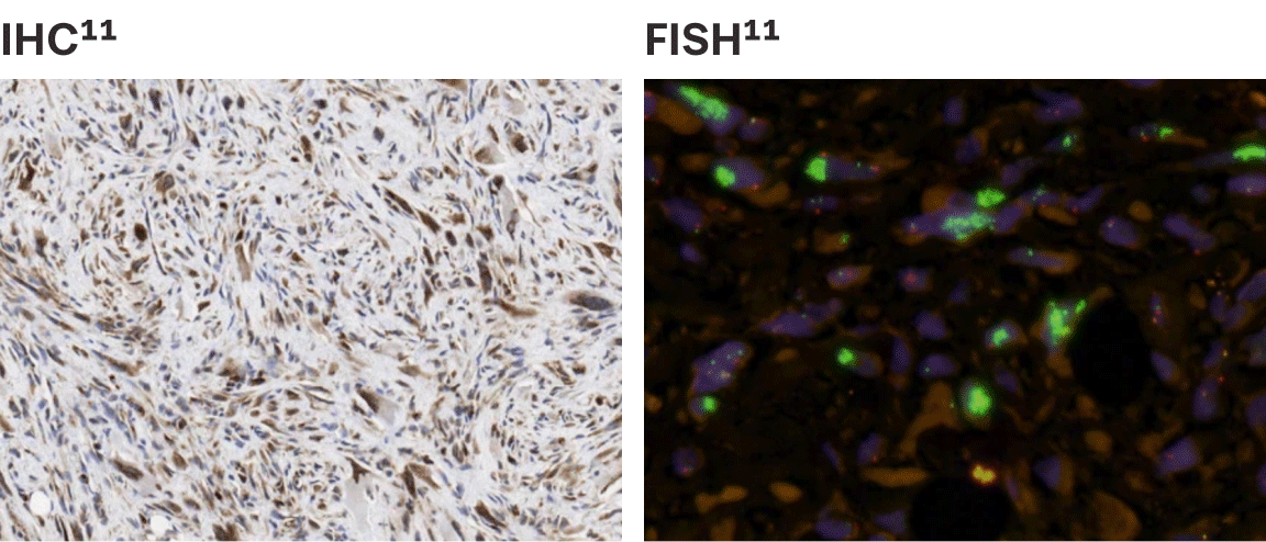 DDLPS IHC and FISH